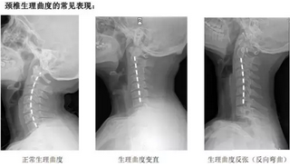 颈椎反弓,容易被忽视的健康杀手。_好大夫在线