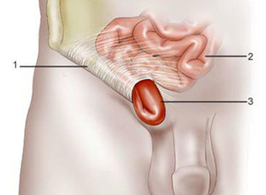 小儿腹股沟疝简介