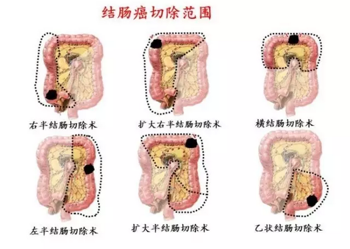 癌肿位于直肠的,因为涉及到肛门功能保留问题,还依据癌肿距肛门距离有