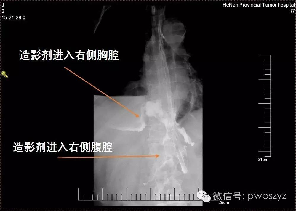 肠瘘肠梗阻典型病例系列之001胃癌术后吻合口瘘