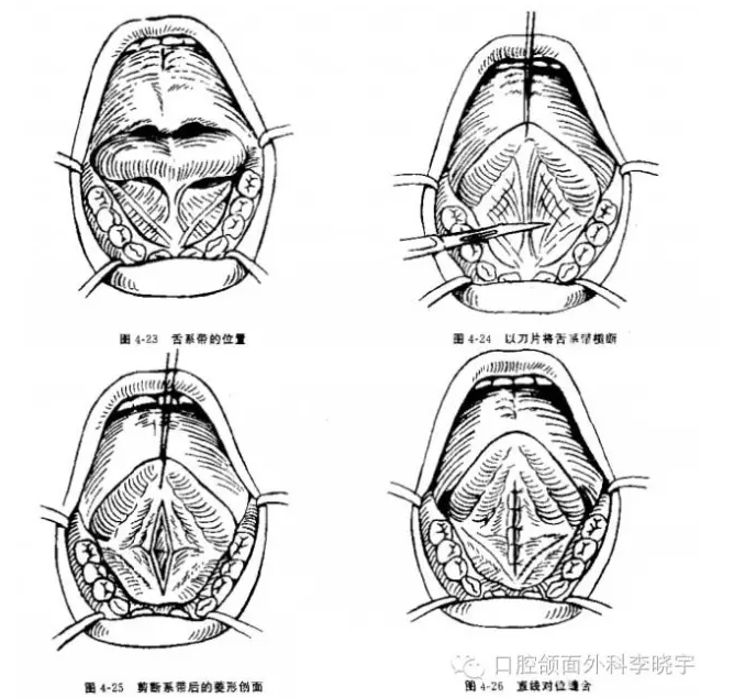 舌系带矫正