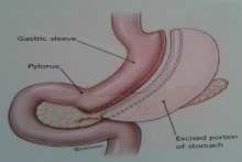 袖状胃切除术(sleeve)
