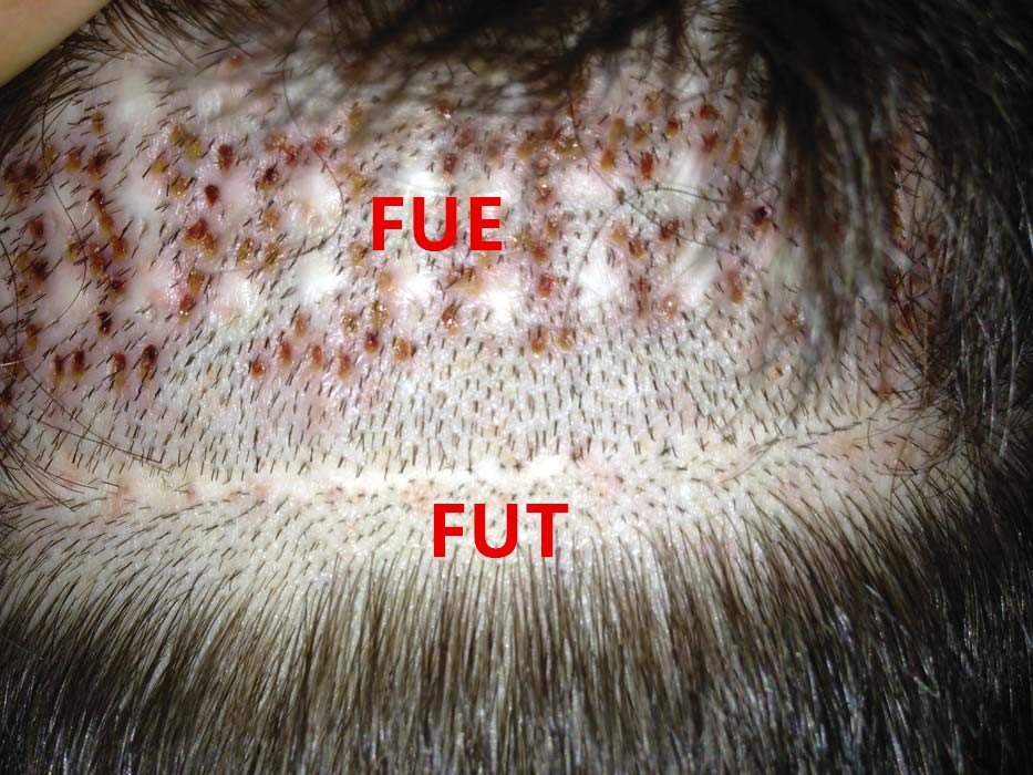 无痕植发真的没有痕迹吗?_好大夫在线