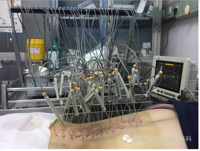 温附一疼痛科引进银质针导热巡检仪开展密集型银质针治疗慢性