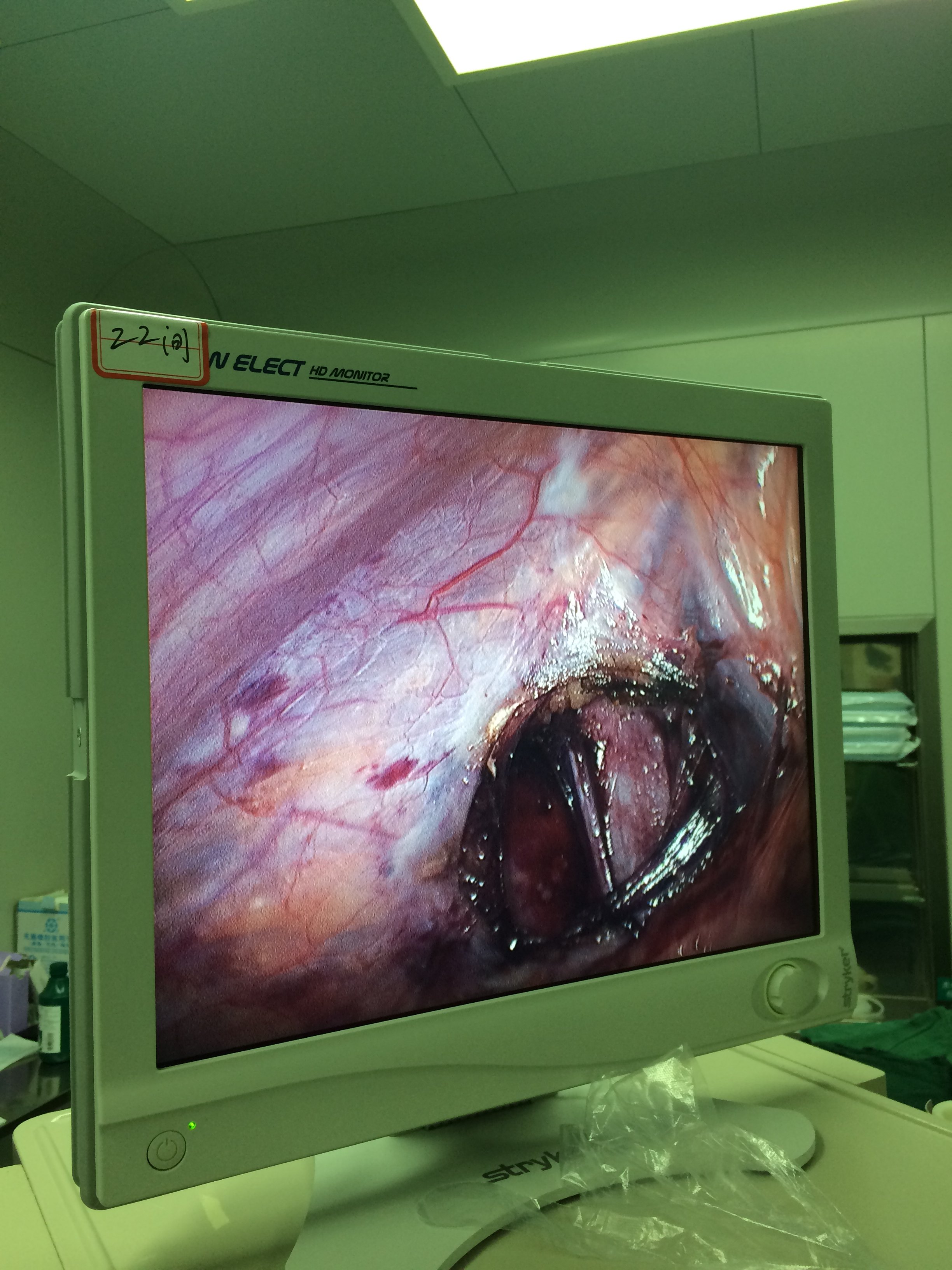 腹腔镜下精索静脉曲张手术前后图