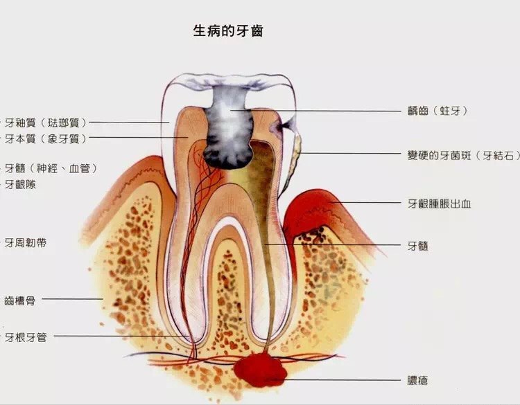 从不洗牙的人牙齿掉的快看看你就明白为啥掉的快了