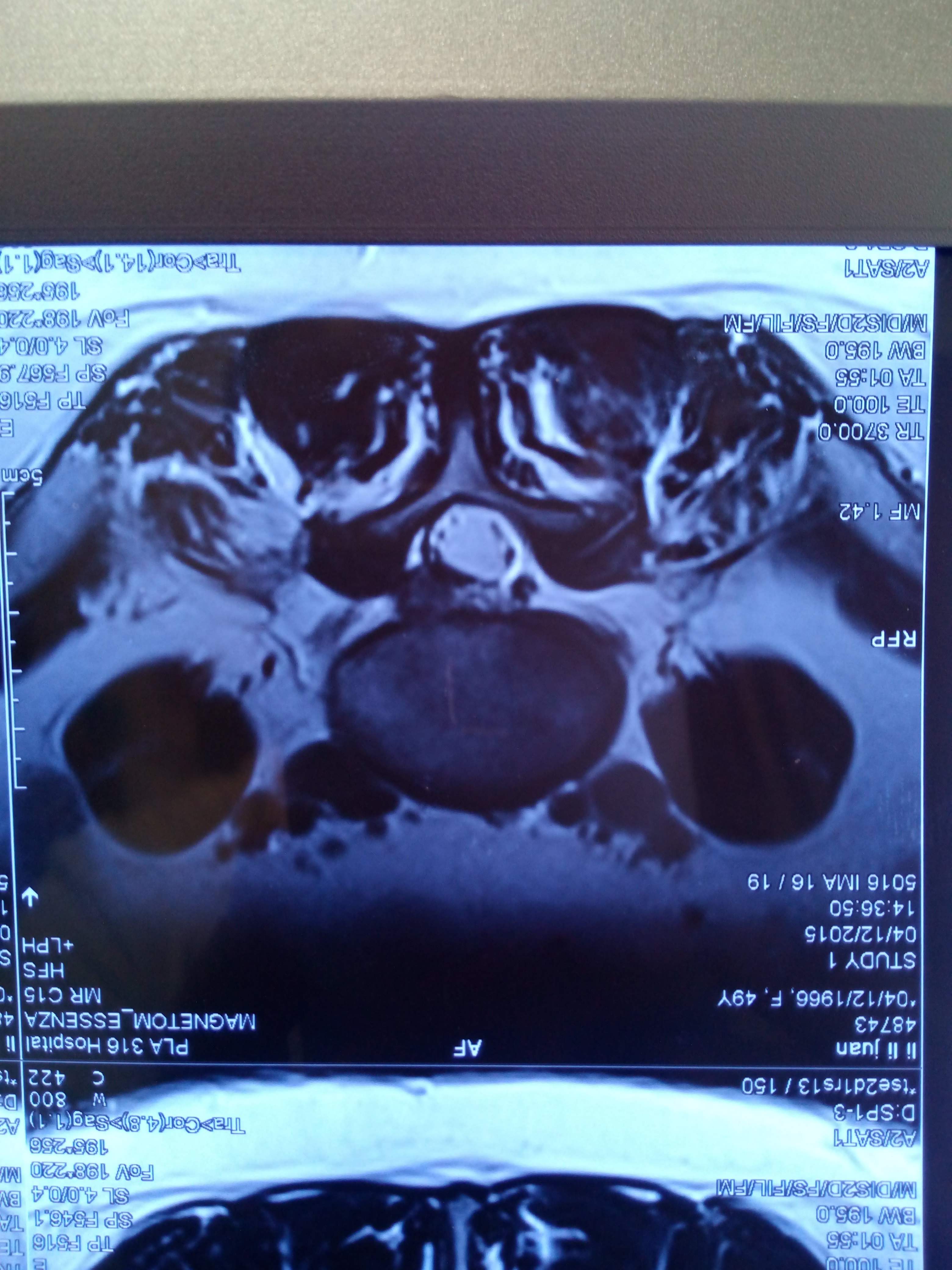 腰椎间盘突出症的微创治疗--椎间孔镜手术的担