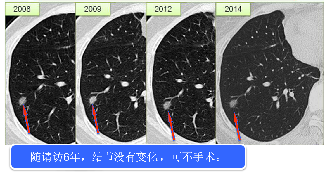 肺癌系列五:肺部发现小结节怎么办?