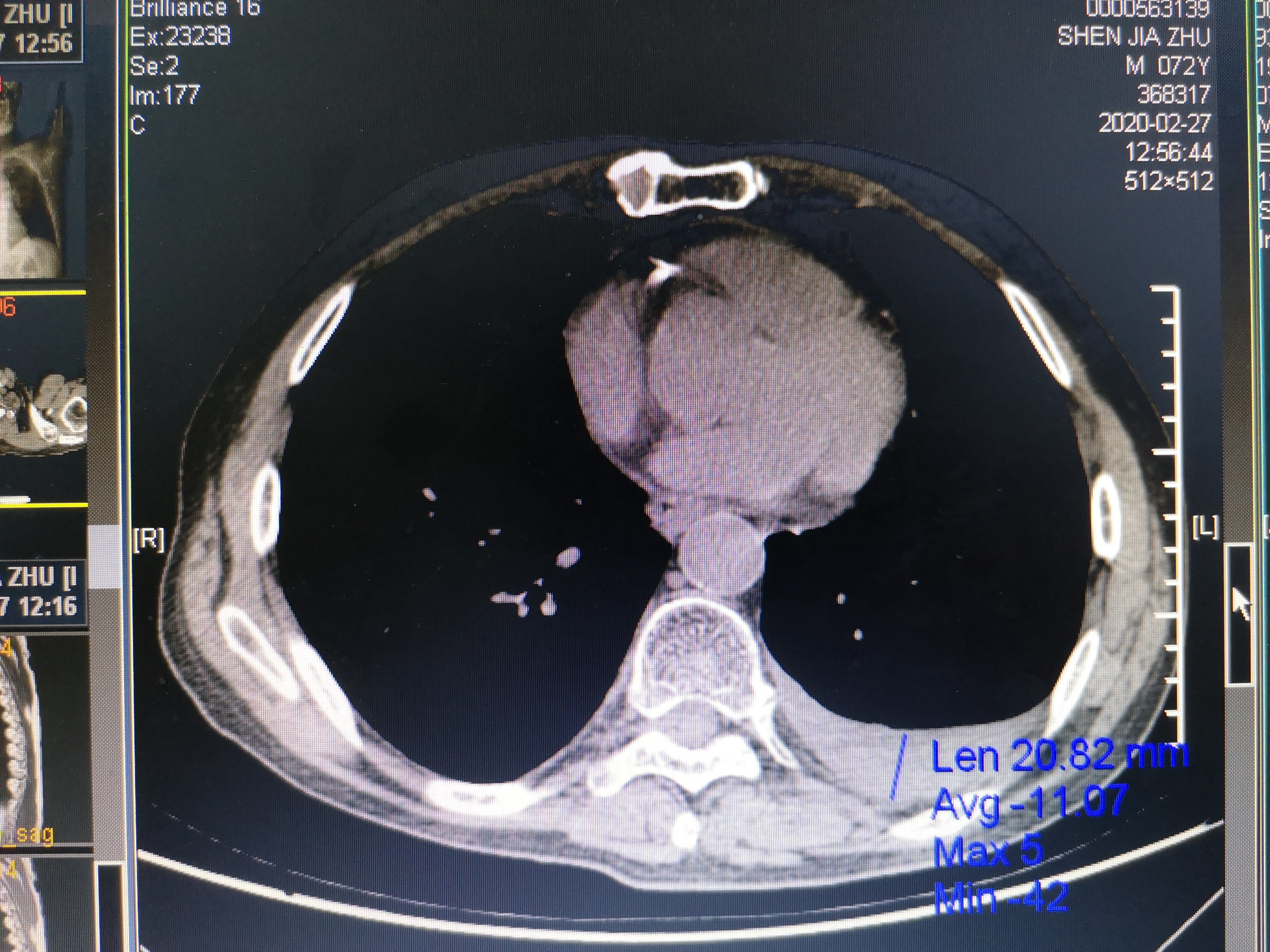 从上面这张ct图我们可以看出这个患者左侧有胸腔积液,就是我上面标注
