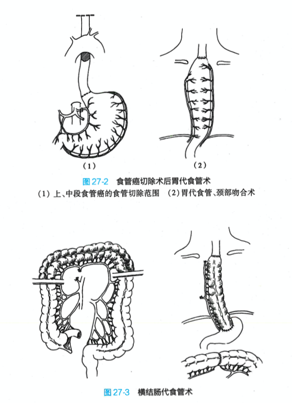 食管癌及其治疗原则_食道癌_食道癌 - 好大夫在线