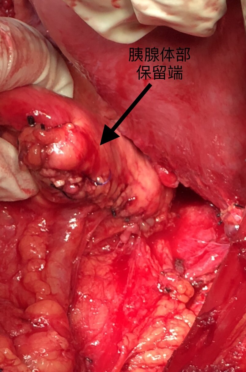 胰腺囊腺癌的胰体尾部切除