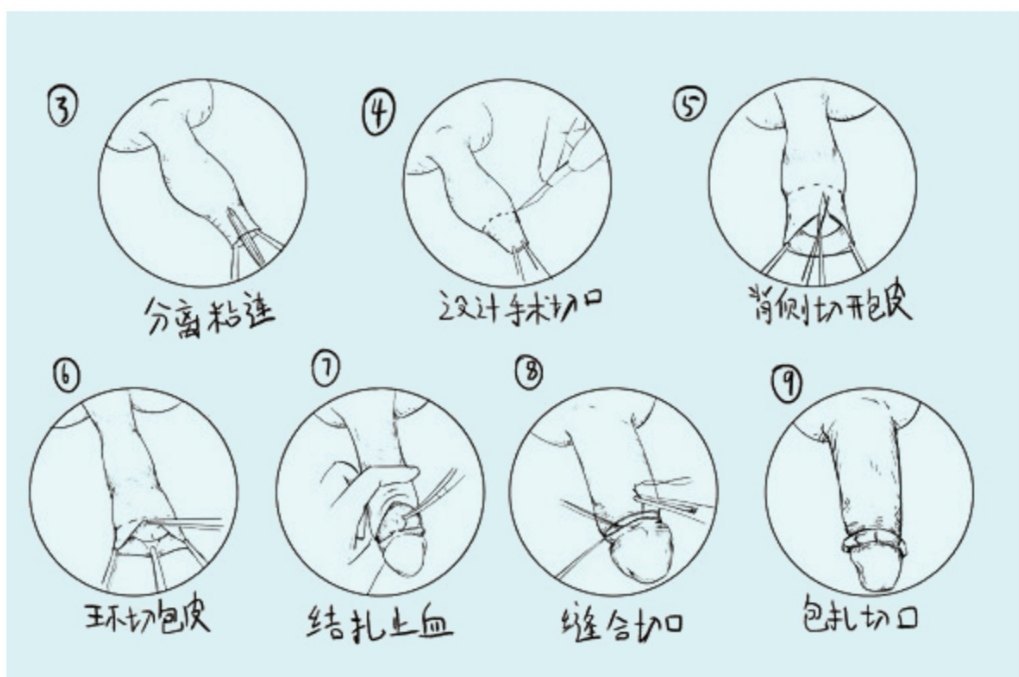传统包皮手术流程?术后注意事项