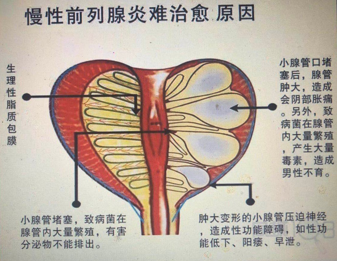 深入虎穴,直捣黄龙的前列腺炎注射疗法,看起来好美,事实如何?