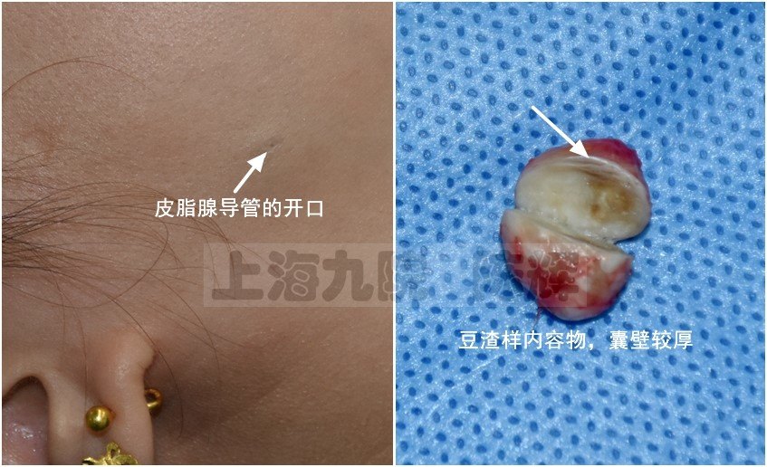 皮脂腺囊肿粉瘤的美容手术标准切除