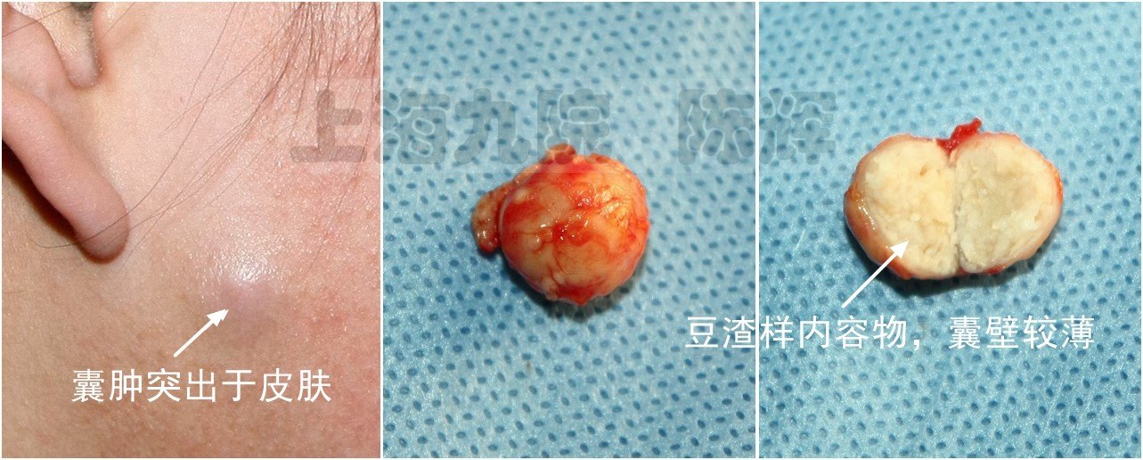 皮脂腺囊肿(粉瘤)的美容手术标准切除