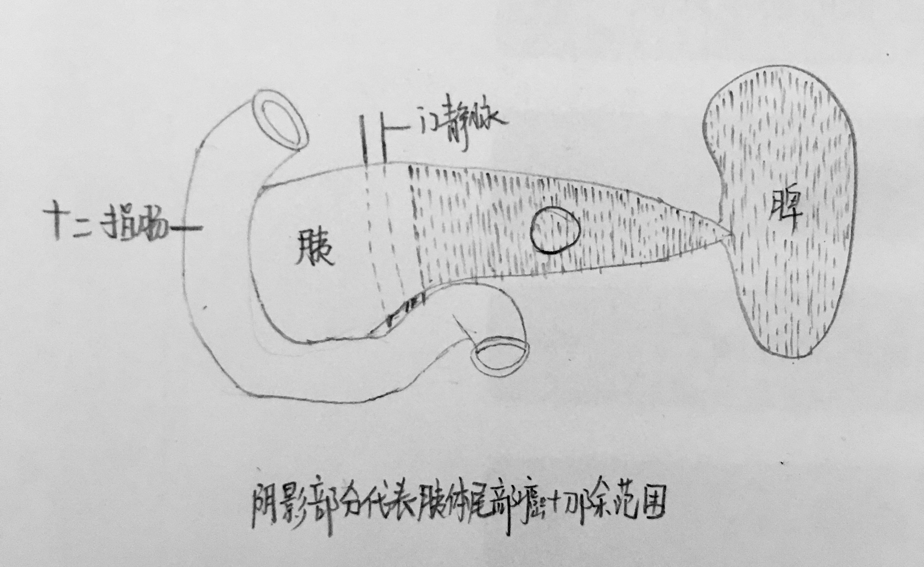 胰腺癌的手术治疗