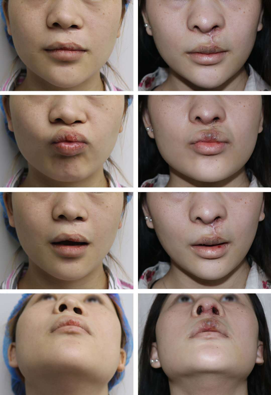常见的唇部整形手术有哪些？如何看待所谓的“微笑唇”手术？-蜜颜优惠