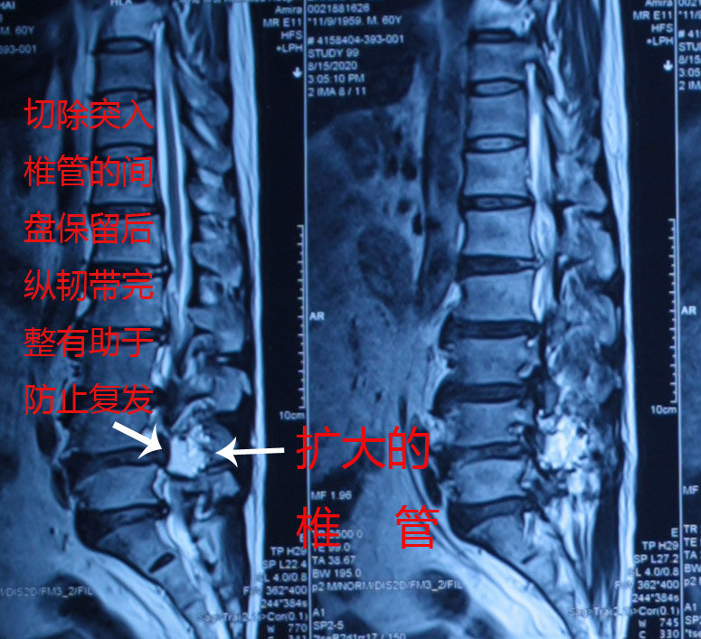 术后磁共振片子