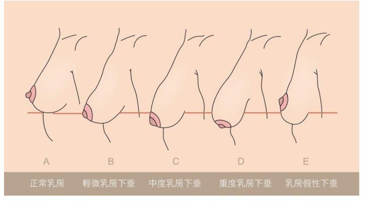 女性乳房下垂的原因是什么?如何改善乳房下垂?