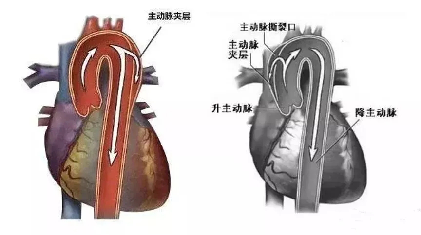 一根关乎生命的血管主动脉夹层