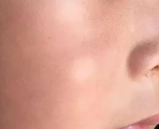 不是白癜风的白斑