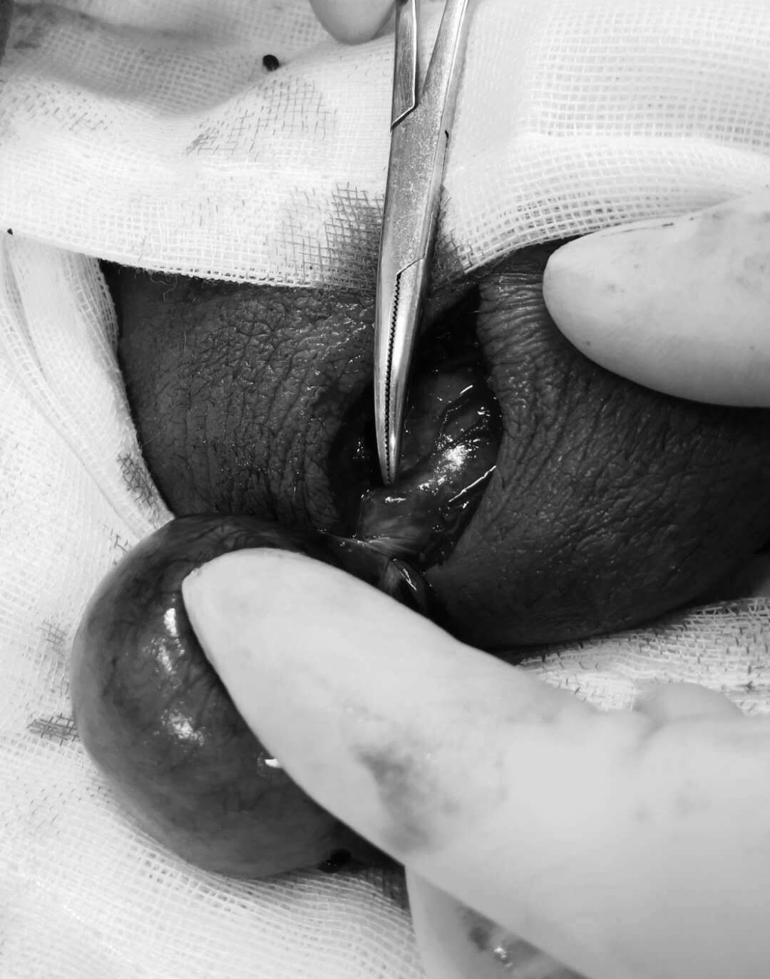选择睾丸复位固定术 对侧睾丸固定术;如睾丸坏死,早期行病侧睾丸切除