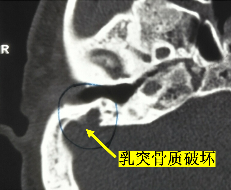 中耳胆固醇肉芽肿