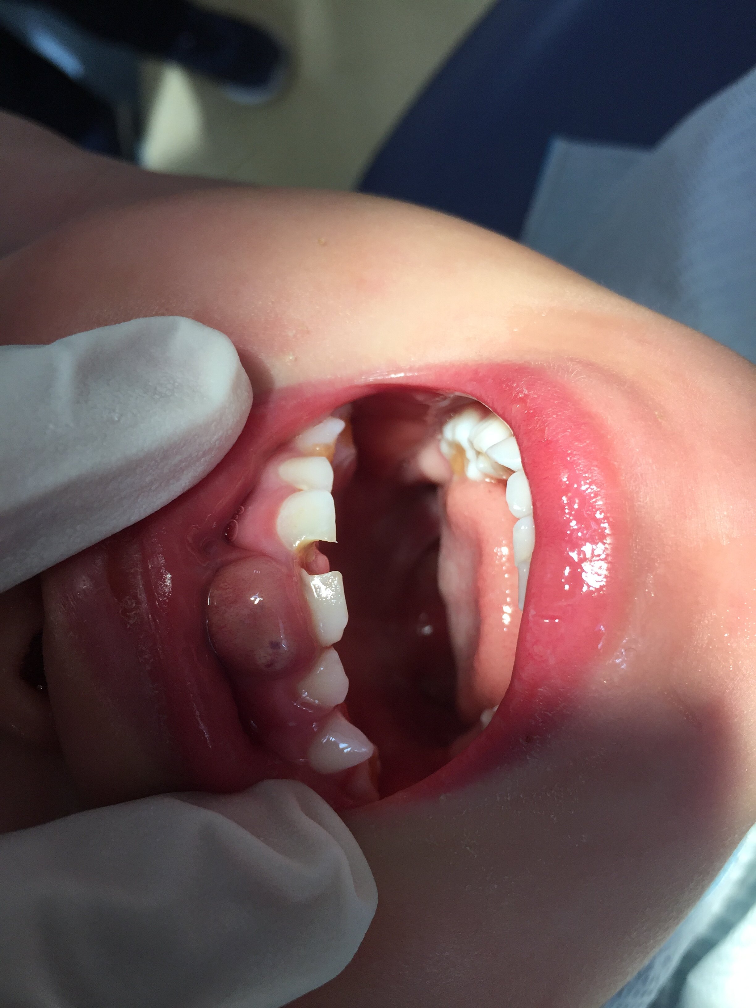 这是一个牙龈起脓包的孩子,你的宝宝是否也有同样的问题刎?