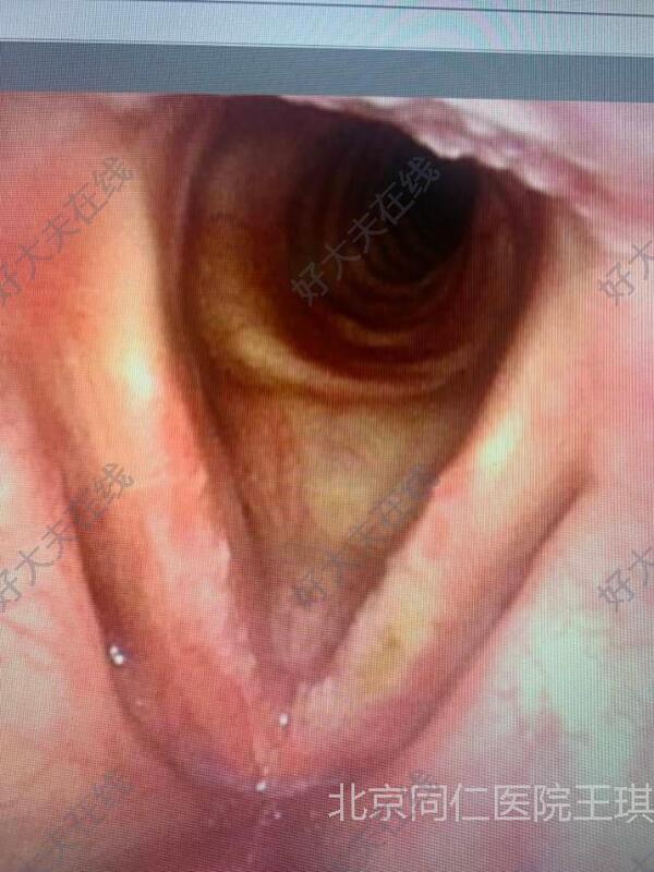 纤维喉镜显示左侧声带局部恢复良好,见疤痕,右侧声带仍见白斑
