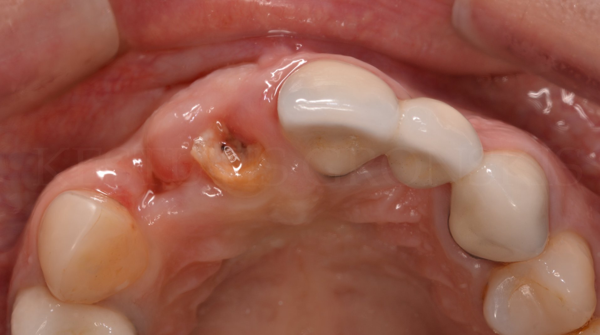 1,患者冠断裂,残根,无法桩核修复,牙根经过完善的根管治疗,牙周健康.