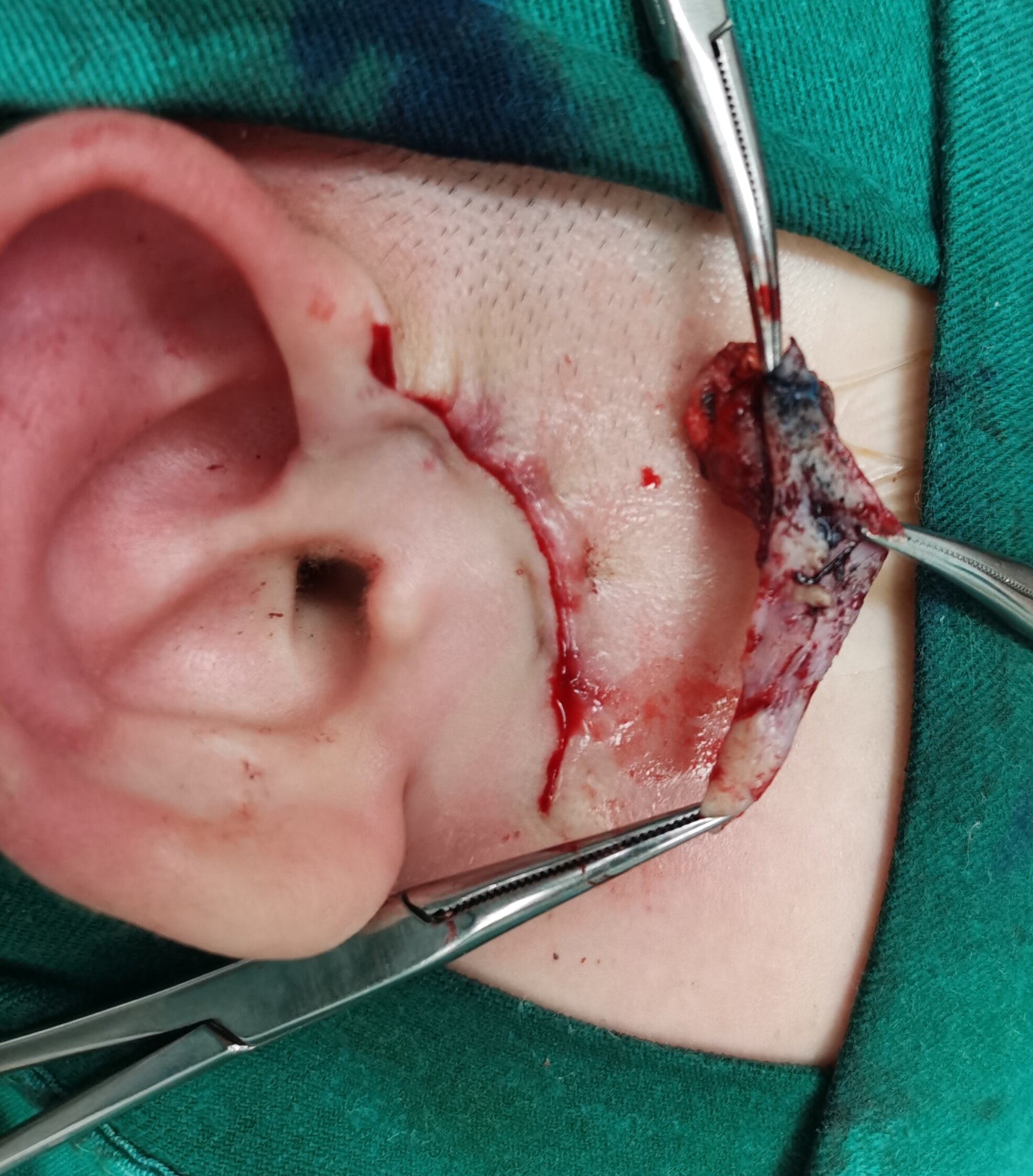 先天性耳前瘘管感染期手术与非感染期手术对比