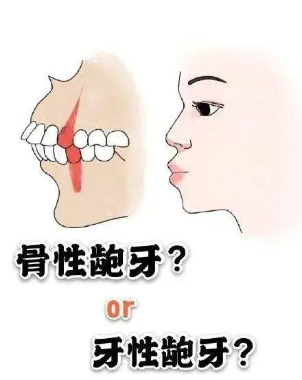 三招教你辨别骨性和牙性龅牙
