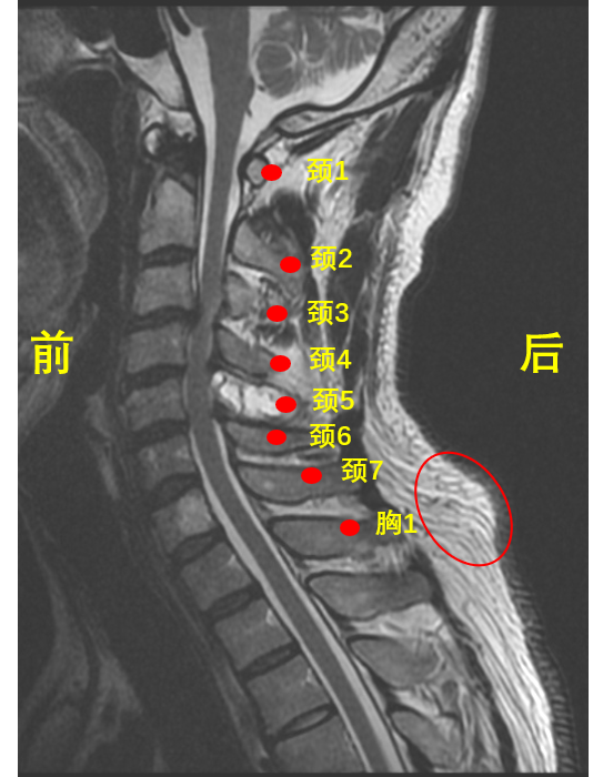 图2:人颈椎磁共振的侧面观.