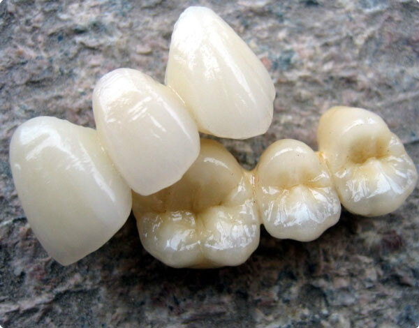 缺点:纯钛金属特性导致与瓷层结合不佳,咀嚼力过大时易崩瓷.