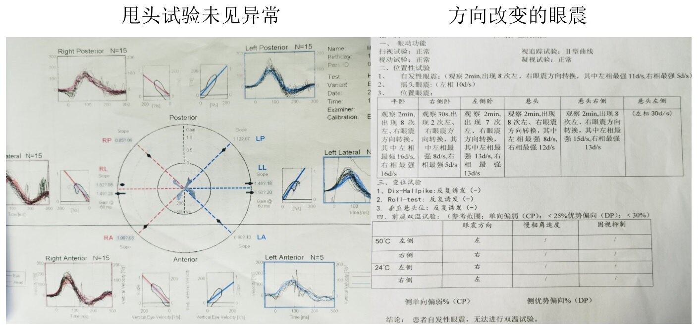 前庭功能评价:甩头试验未见异常,位置试验可见方向改变的眼震,眩晕