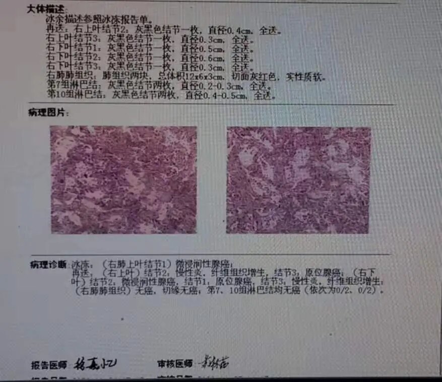 72岁多发磨玻璃结节肺癌能手术吗患者专程从加拿大回国手术