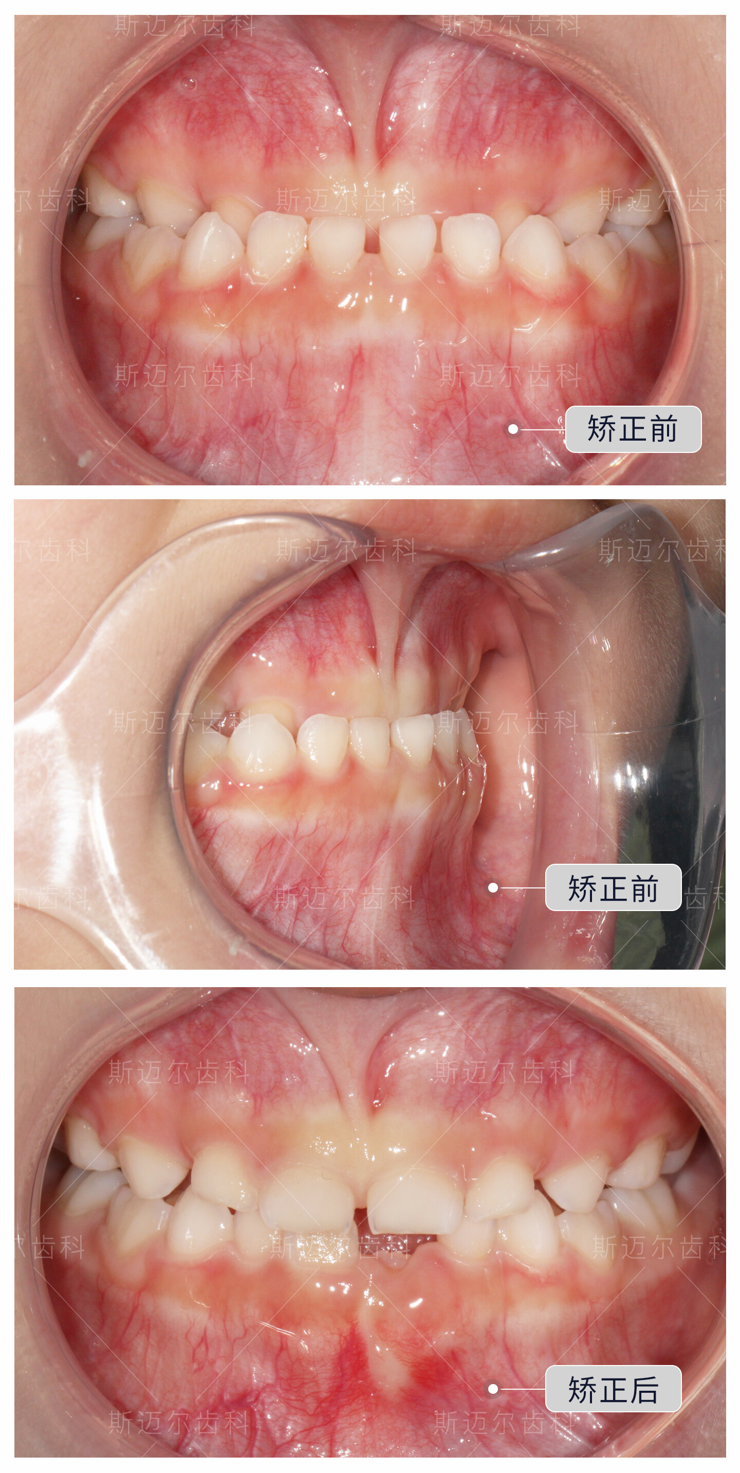 4岁宝宝牙齿反合(地包天),4个月时间纠正_牙颌畸形_牙