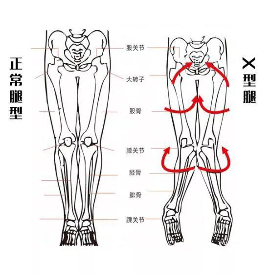 x型腿是内八吗