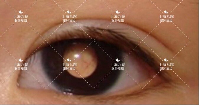 眼内肿瘤:如视网膜母细胞瘤小宝宝,表现为白瞳症
