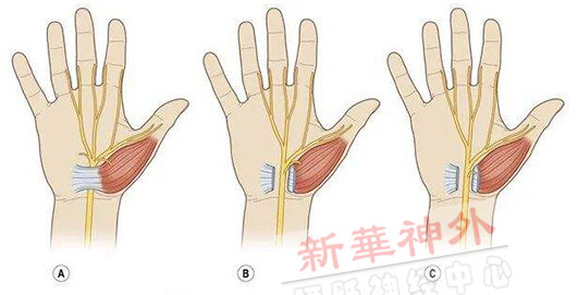 c韧带内穿出(起自韧带内,从韧带内穿出,主要支配拇短展肌和拇对掌肌