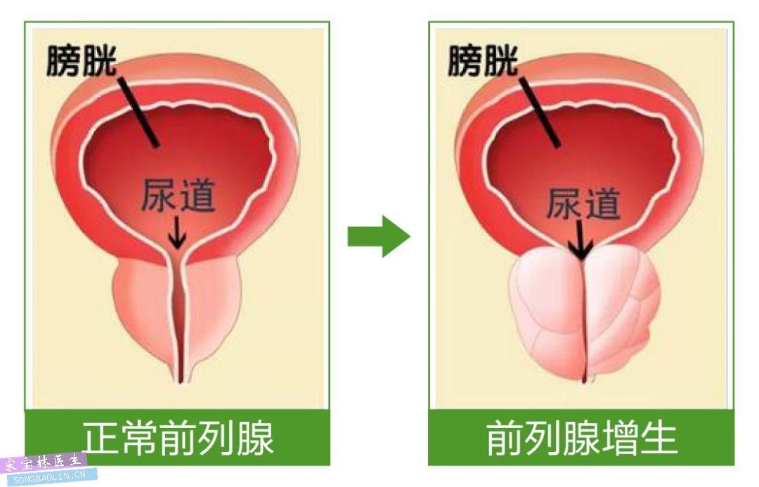 前列腺增生示意图