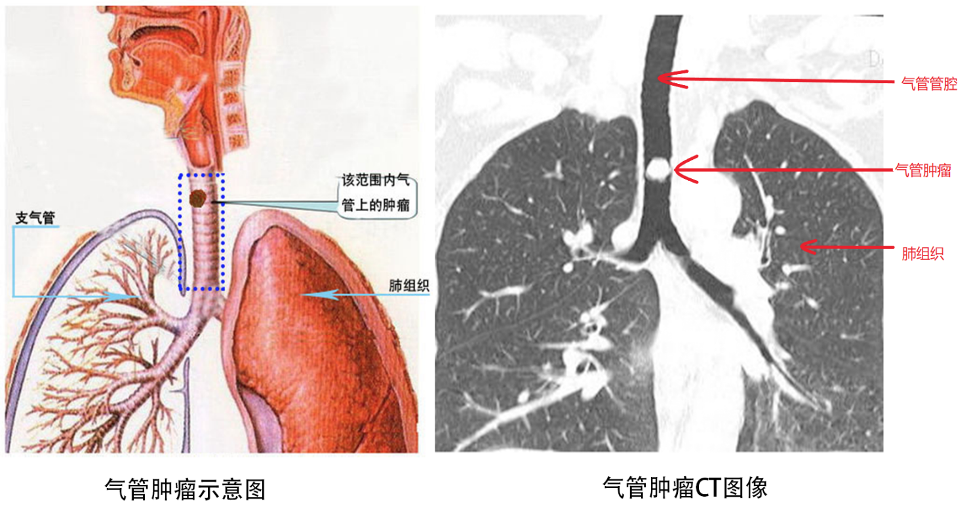 什么是气管肿瘤有哪些表现需要警惕