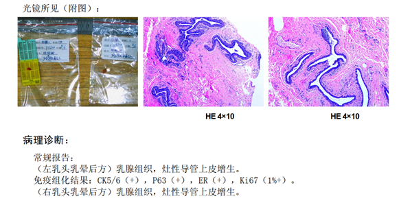 手术病理新看点四乳腺小叶原位癌是乳腺癌吗