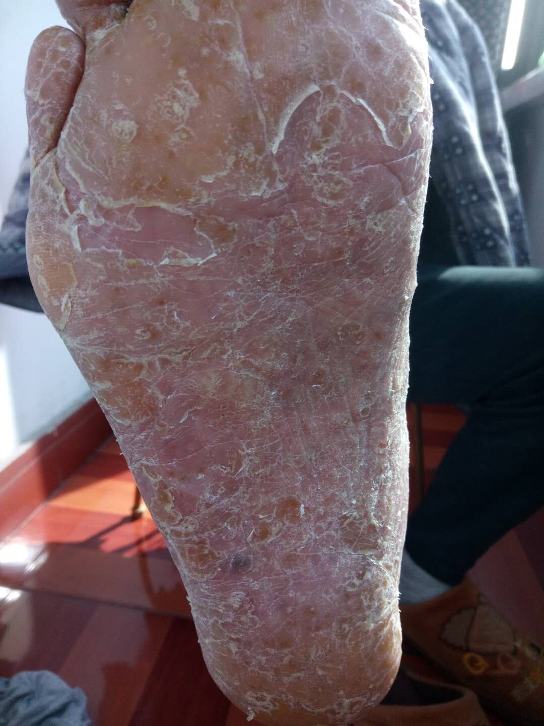 什么是掌跖脓疱病?