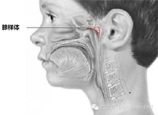 儿童夜间睡眠为什么打呼噜浅谈腺样体肥大