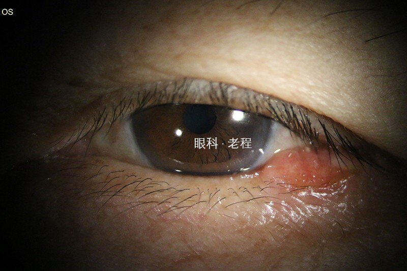 眼皮小小的肉芽,须当心,可能是眼睑癌的早期表现
