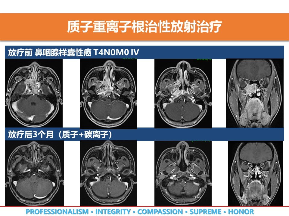 病例二:鼻咽腺样囊性癌患者,病灶通过鼻咽腔侵犯至鼻后孔,颅底,眼眶后