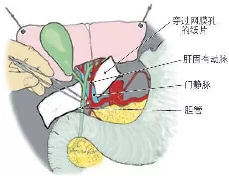 肝门部胆管癌的治疗