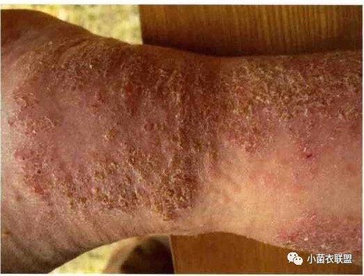 关于湿疹你究竟了解多少?