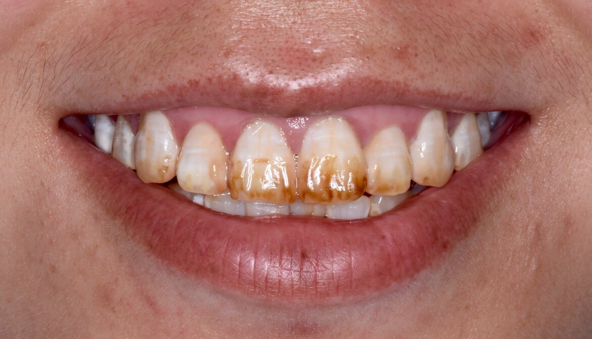 图四:氟斑牙导致的牙齿颜色发黄